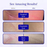 Rejuvasil Silicone Scar Gel 15Ml