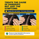 Nizoral Shampoo 100ml – 2% Ketoconazole Anti-Dandruff Treatment