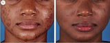 Zoskin Oil Control Pads Acne Treatment 60Pads